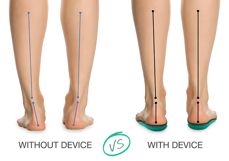 Anti-Supination Device - Image 6